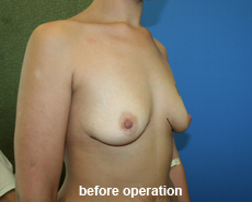 plastic-surgery-breast-augmentation